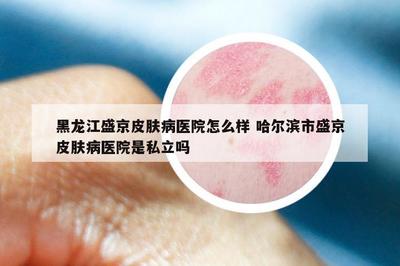 黑龍江盛京皮膚病醫(yī)院怎么樣 哈爾濱市盛京皮膚病醫(yī)院是私立嗎