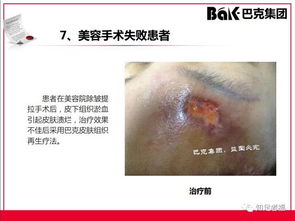 一切皮膚病及外傷的克星,傳統(tǒng)文化義工的事業(yè) 巴克產(chǎn)品介紹