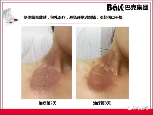 一切皮膚病及外傷的克星,傳統(tǒng)文化義工的事業(yè) 巴克產(chǎn)品介紹