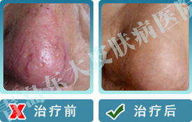 酒槽鼻患者秋季應(yīng)該怎么護理