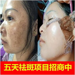 五天祛斑加盟廢多少錢,祛斑揭膜好用嗎,十八專業(yè)祛斑招商總部