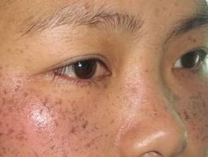 去黃褐斑多年未果,嘗盡各種辦法都無效,其實去它就應(yīng)該用專業(yè)祛斑產(chǎn)品