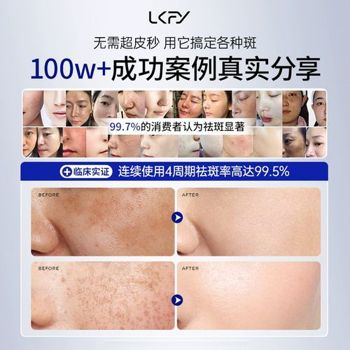 什么牌子淡斑效果最好最安全 專業淡斑體驗分享