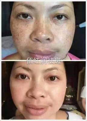 佰紅潤一次性祛斑專家