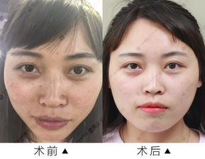 祛斑后出現返黑 燙傷 永久性疤痕等后遺癥 都是因為你用錯了它