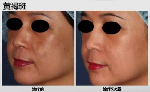 春語祛斑神器 蜂巢皮秒為何如此火爆