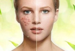 專業(yè)祛斑祛痘加盟連鎖項(xiàng)目 開啟美麗事業(yè)，共創(chuàng)健康肌膚未來